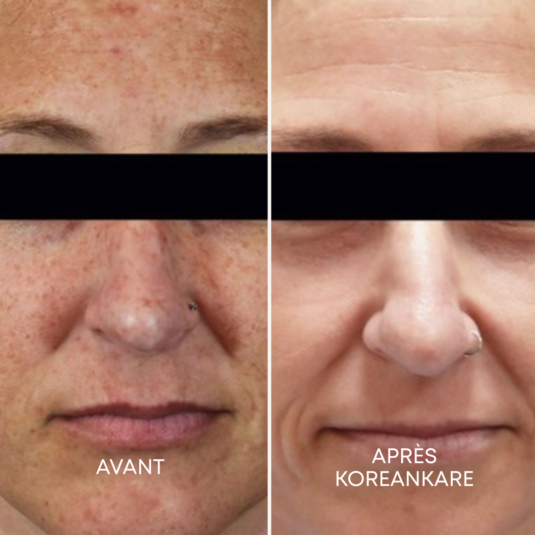 GlowSkin Pure® - Crème Anti-Taches