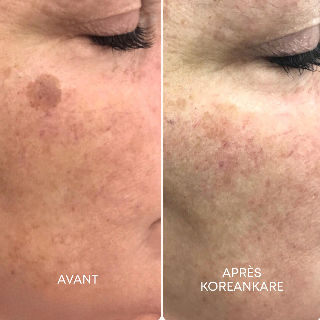 GlowSkin Pure® - Crème Anti-Taches